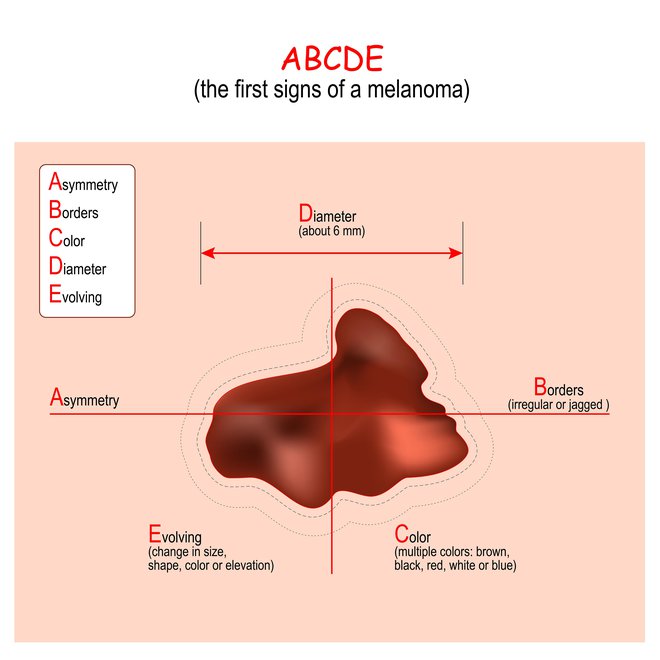 Dobra preventiva zgodnjega odkrivanja melanoma je sistem ABCDE - asimetrija, nejasni robovi znamenj, več odtenkov rjave, črne, rdeče, bele ali modre barve, premer (več kot 5 mm). Pa tudi F - melanomske lezije. FOTO: Ttsz/gettyimages