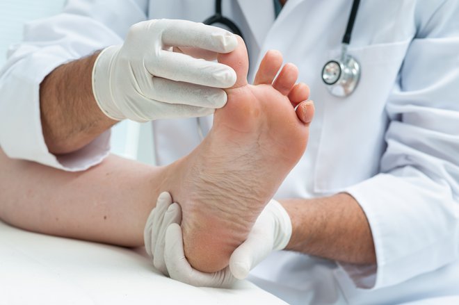 Pri mnogih se bolečine razvijejo zaradi ploskega stopala. FOTO: Alexraths Getty Images/istockphoto